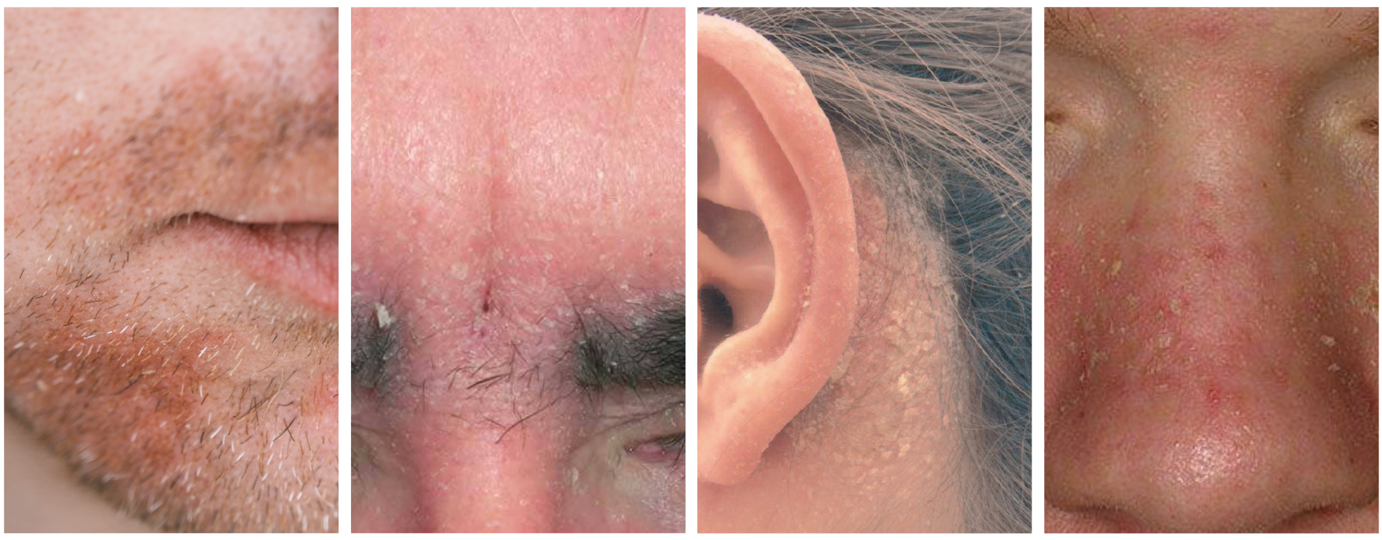 seboroická dermatitida